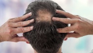 Uzman açıkladı… Saç dökülmesi yaşayan erkekler bunları tüketebilir